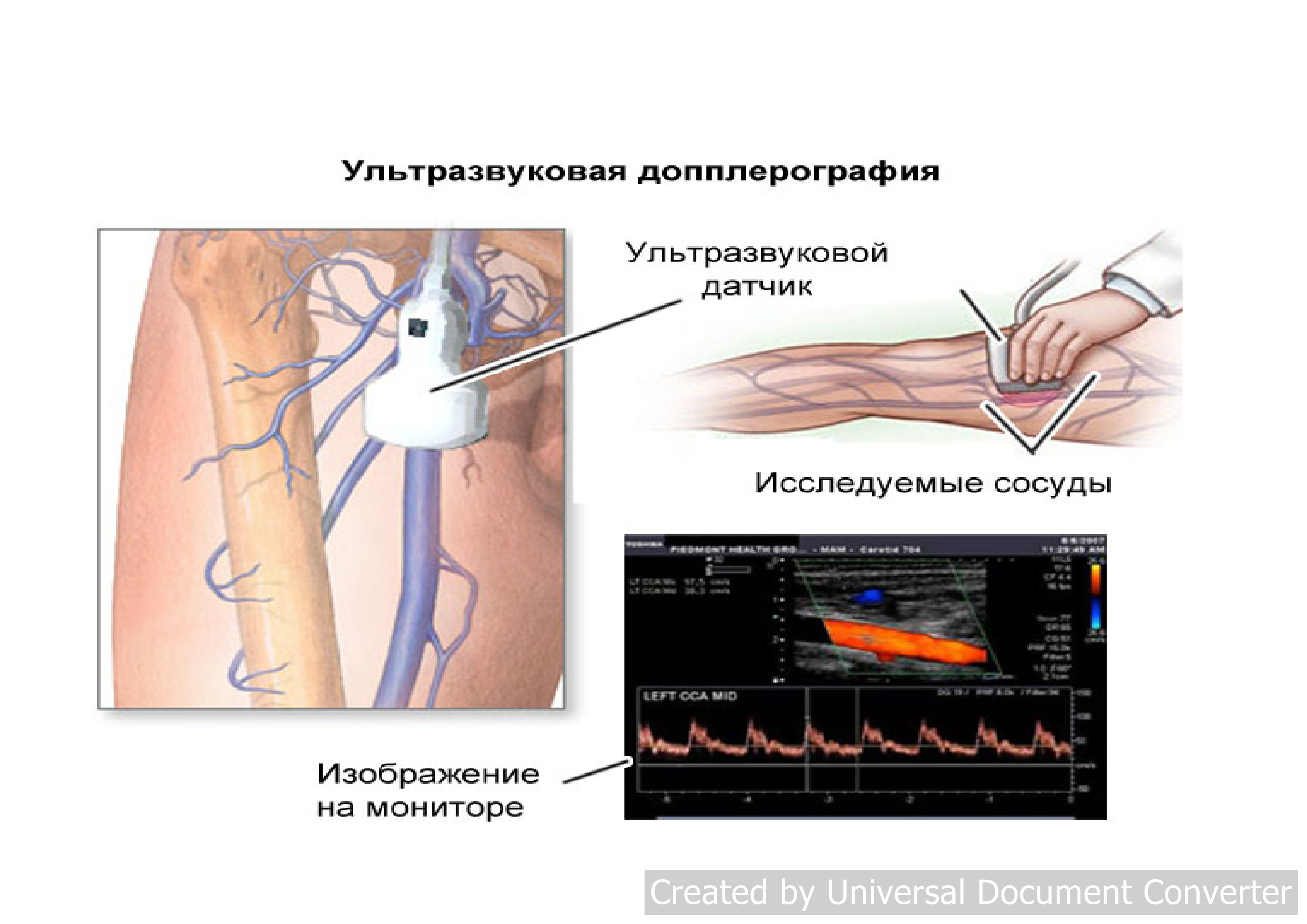Ультразвуковая допплерография артерий нижних конечностей